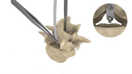 Implanet annonce la signature avec 8i Robotics Inc d'un accord de partenariat.