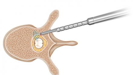 SpineGuard dispose de 650 kE de trésorerie au 31 mars